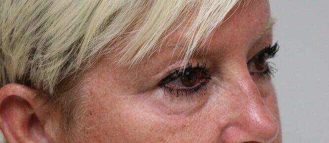 Lower Blepharoplasty Before & After Image