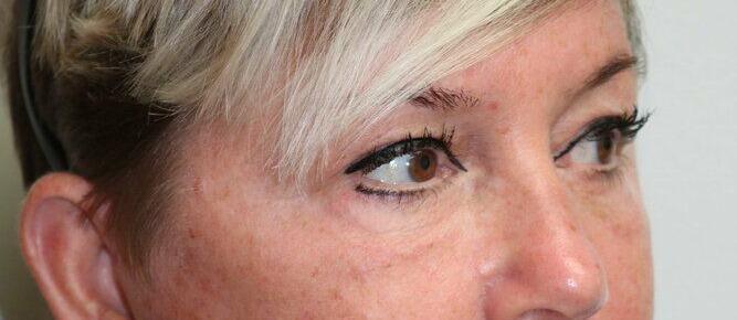 Lower Blepharoplasty Before & After Image