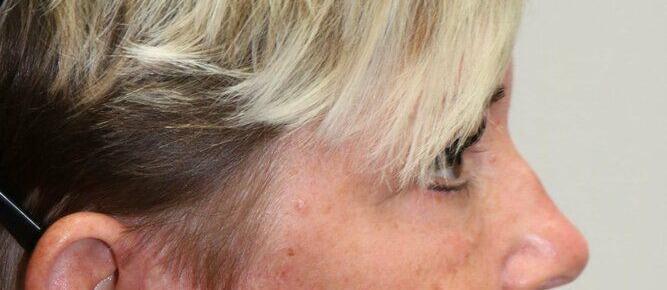 Lower Blepharoplasty Before & After Image