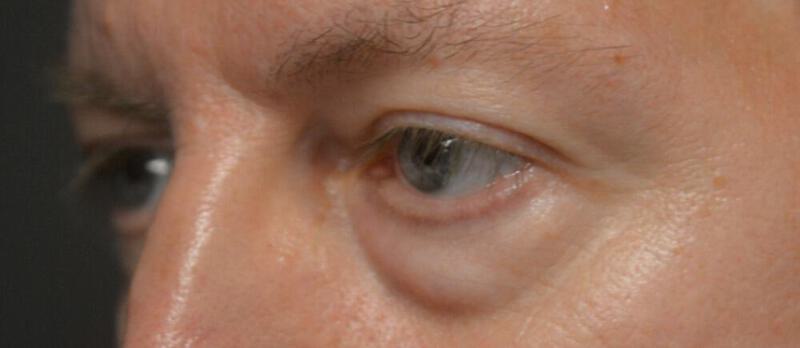 Lower Blepharoplasty Before & After Image