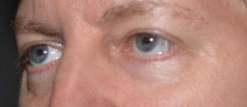 Lower Blepharoplasty Before & After Image