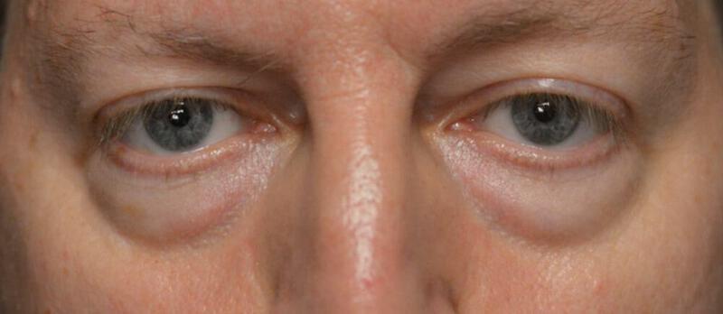 Lower Blepharoplasty Before & After Image