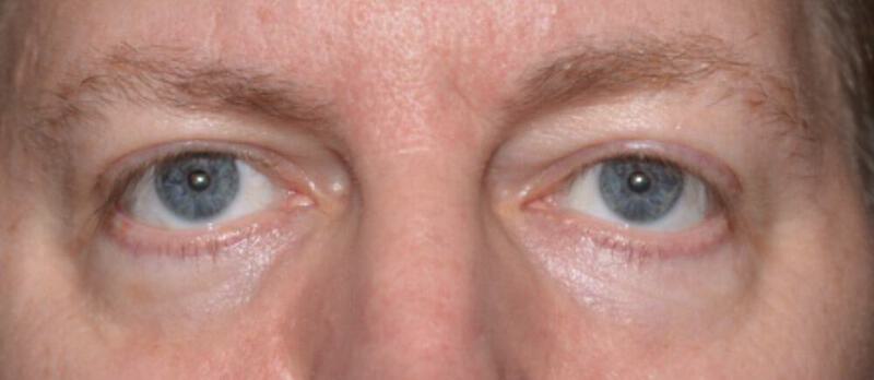 Lower Blepharoplasty Before & After Image