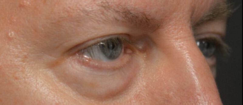 Lower Blepharoplasty Before & After Image