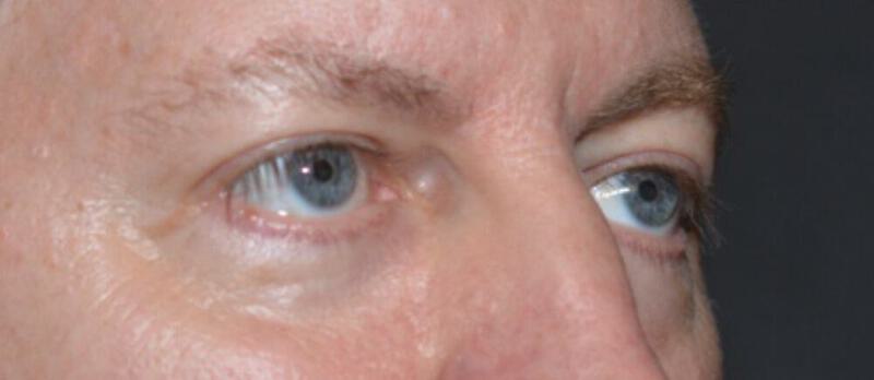 Lower Blepharoplasty Before & After Image