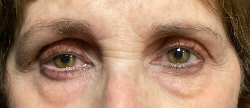 Lower Blepharoplasty Before & After Image