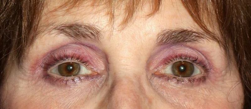 Lower Blepharoplasty Before & After Image