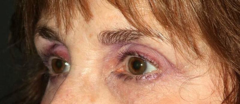 Lower Blepharoplasty Before & After Image