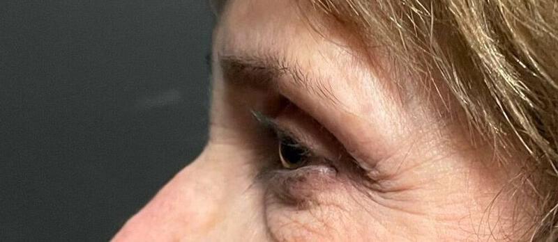 Lower Blepharoplasty Before & After Image