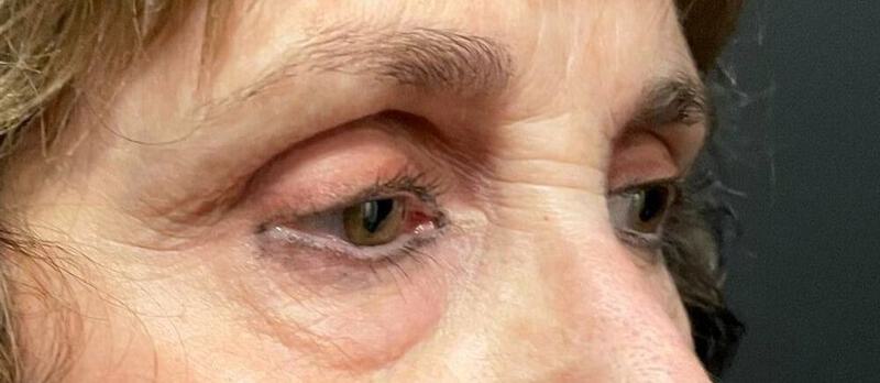 Lower Blepharoplasty Before & After Image