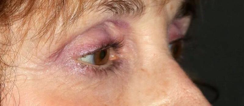 Lower Blepharoplasty Before & After Image