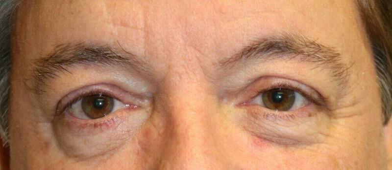 Lower Blepharoplasty Before & After Image