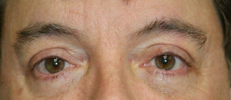 Lower Blepharoplasty Before & After Image