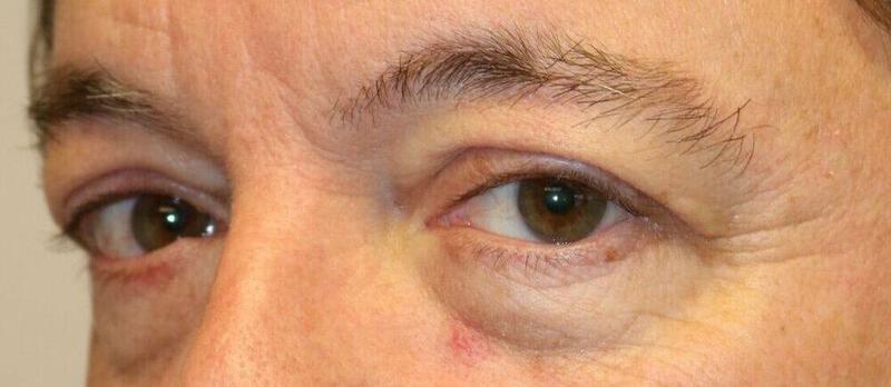 Lower Blepharoplasty Before & After Image