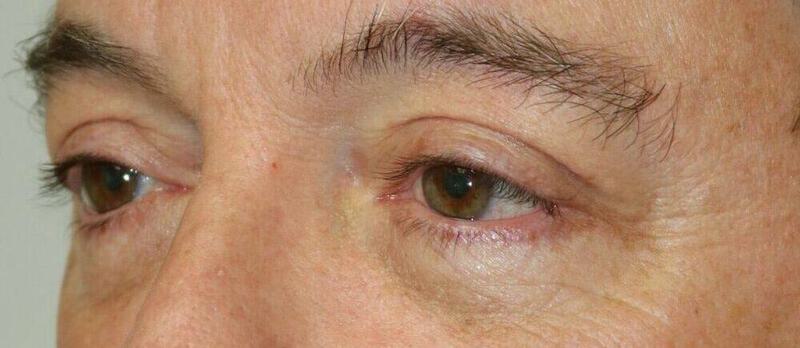 Lower Blepharoplasty Before & After Image