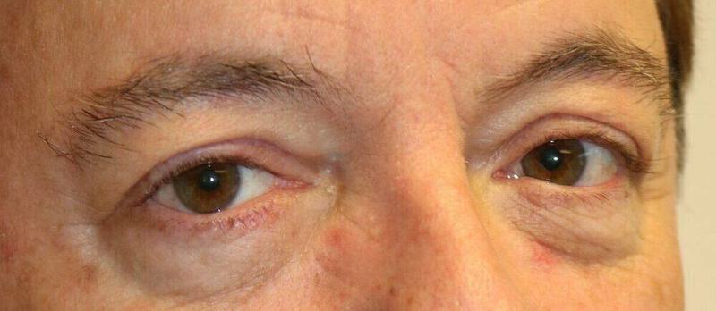 Lower Blepharoplasty Before & After Image