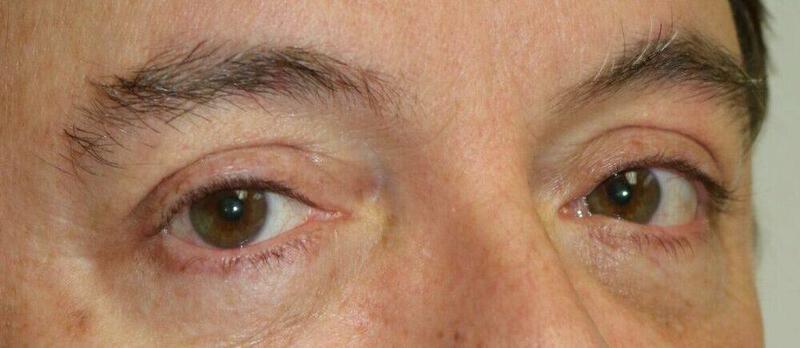 Lower Blepharoplasty Before & After Image