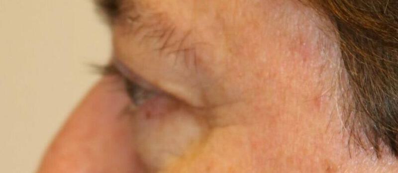 Lower Blepharoplasty Before & After Image