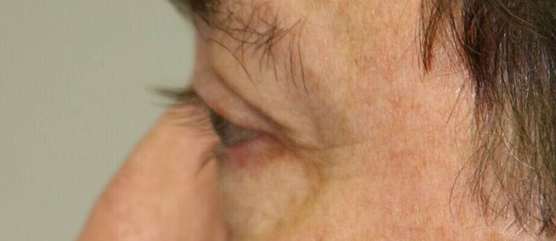 Lower Blepharoplasty Before & After Image