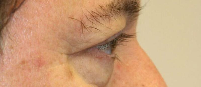 Lower Blepharoplasty Before & After Image