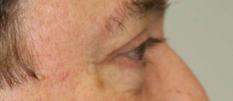 Lower Blepharoplasty Before & After Image