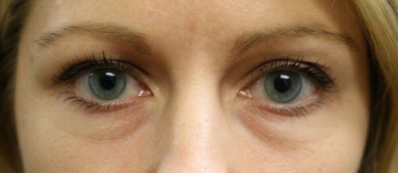 Lower Blepharoplasty Before & After Image