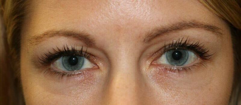 Lower Blepharoplasty Before & After Image