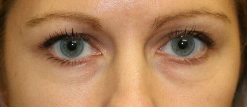 Lower Blepharoplasty Before & After Image