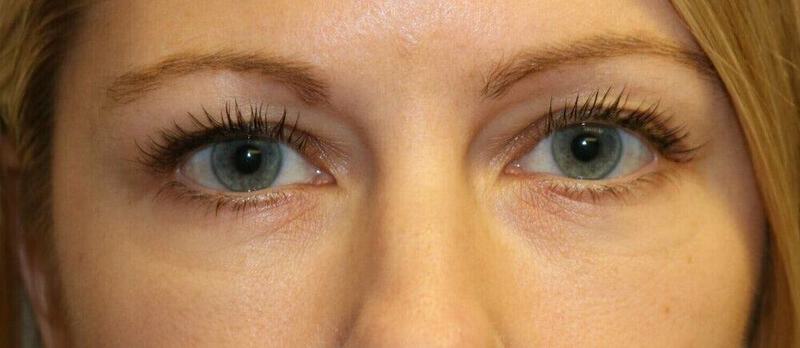 Lower Blepharoplasty Before & After Image