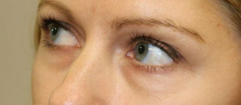 Lower Blepharoplasty Before & After Image