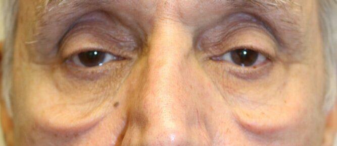 Lower Blepharoplasty Before & After Image