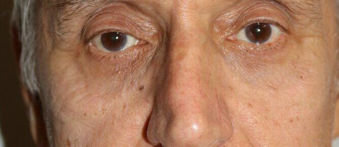 Lower Blepharoplasty Before & After Image