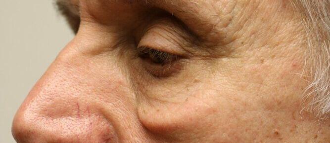 Lower Blepharoplasty Before & After Image