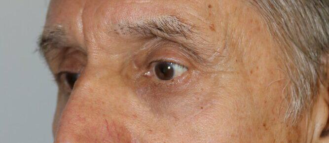 Lower Blepharoplasty Before & After Image