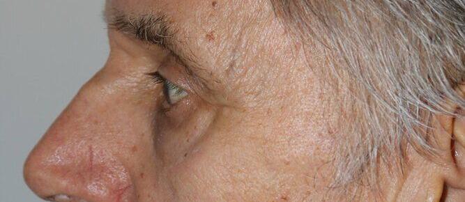 Lower Blepharoplasty Before & After Image