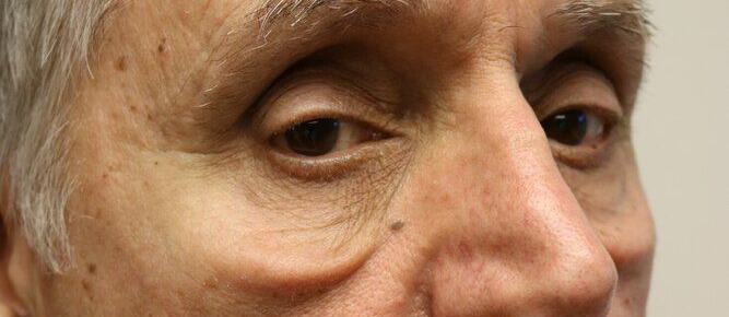 Lower Blepharoplasty Before & After Image