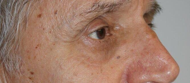 Lower Blepharoplasty Before & After Image