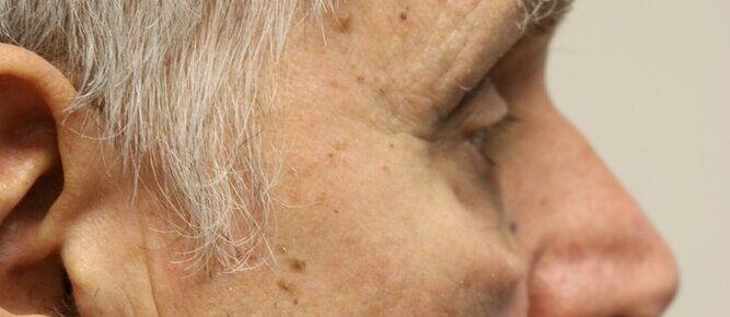 Lower Blepharoplasty Before & After Image