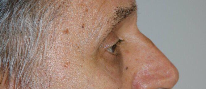 Lower Blepharoplasty Before & After Image