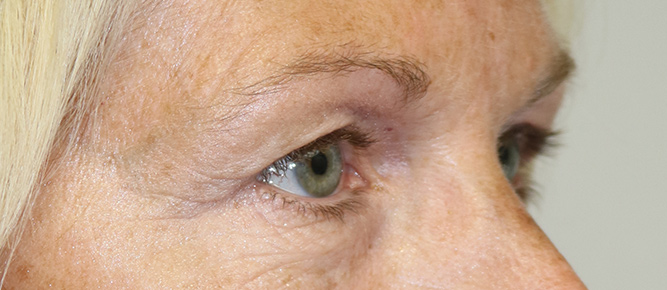 Lower Blepharoplasty Before & After Image