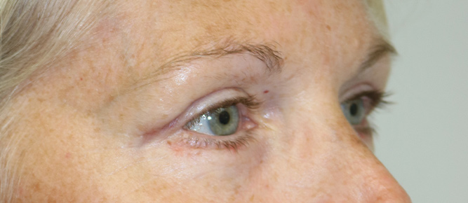 Lower Blepharoplasty Before & After Image