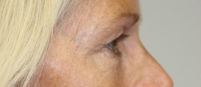 Lower Blepharoplasty Before & After Image