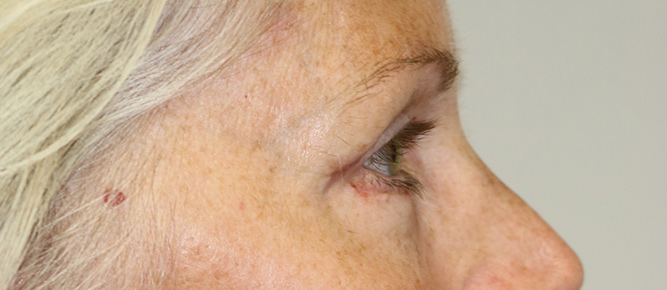 Lower Blepharoplasty Before & After Image