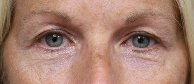 Lower Blepharoplasty Before & After Image