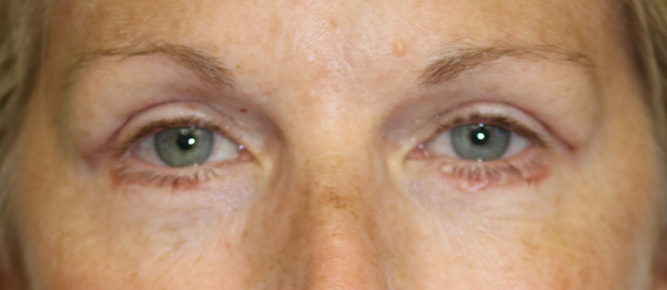 Lower Blepharoplasty Before & After Image