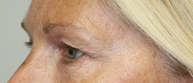 Lower Blepharoplasty Before & After Image