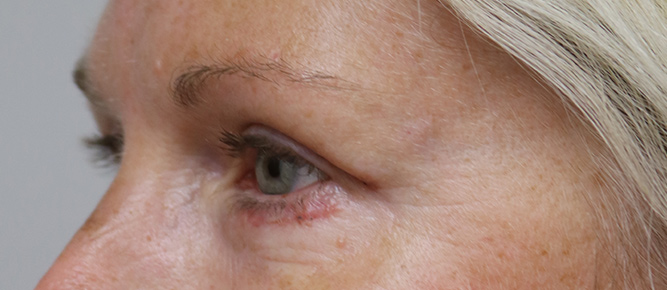 Lower Blepharoplasty Before & After Image