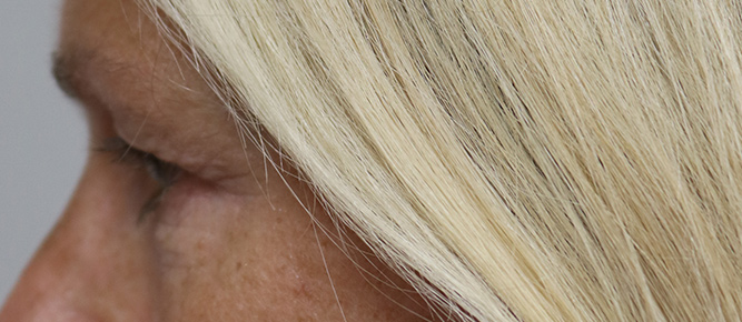 Lower Blepharoplasty Before & After Image