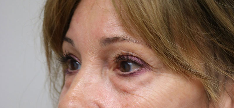 Lower Blepharoplasty Before & After Image