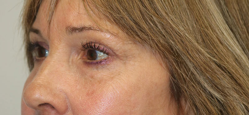 Lower Blepharoplasty Before & After Image